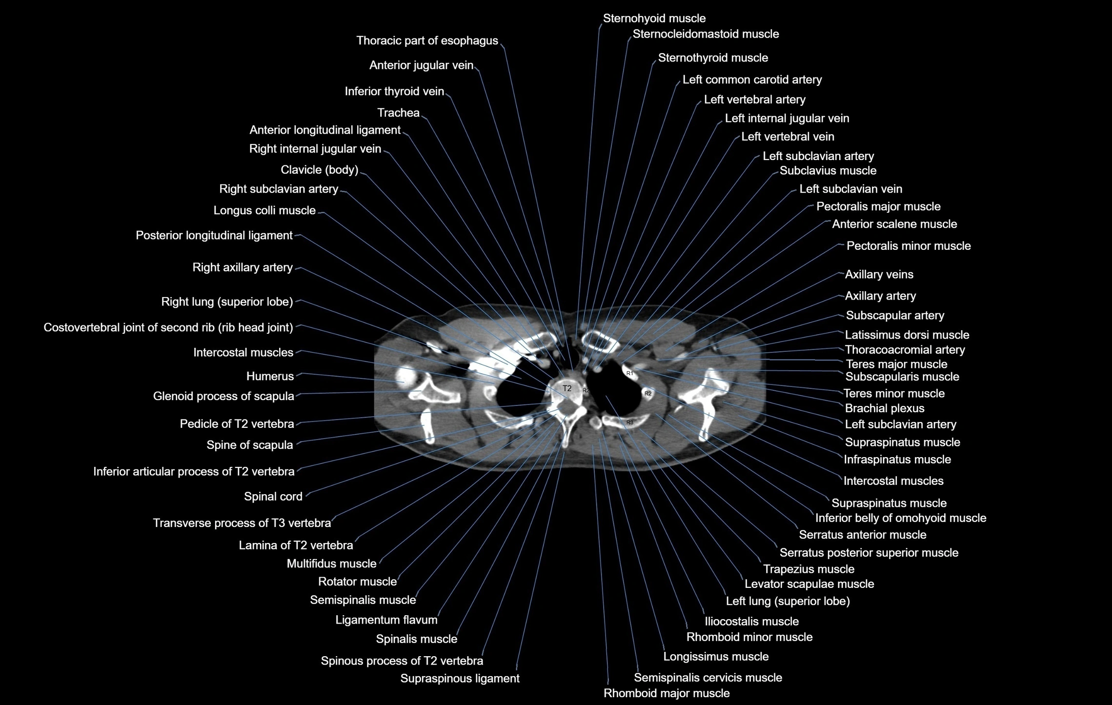 CT chest (thorax) soft tissue window labelled axial cross sectional anatomy radiology image-00012.webp